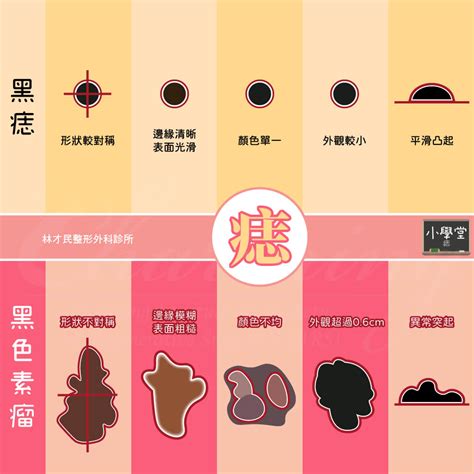 身體:acsf1ltef_m= 痣的位置|【小學堂】為什麼皮膚會長出黑黑的『痣』？ 